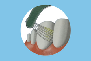 Buletedan-Technologie